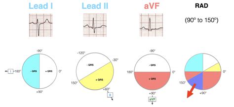 borderline ecg rightward axis.